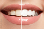 Teeth Whitening