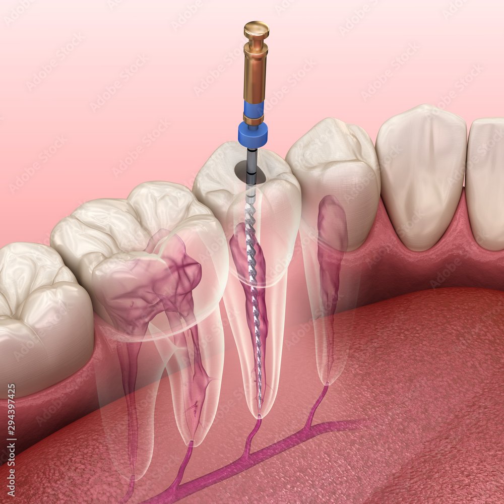 Root Canal Treatment